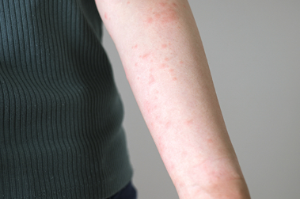 몸에 생기는 가려운 붉은 반점