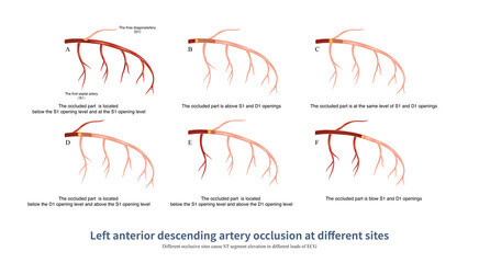 심장마비 전조증상, 원인과 예방하는 방법을 알아봤습니다. 심장은 순환계의 중심 기관으로 심방 및 심실 심장 판막으로 구성됩니다. 인체에 심장은 그 무엇보다 중요한 기관이기 때문에 심장마비 전조증상에 대해 잘 알고 계셔야 합니다.
