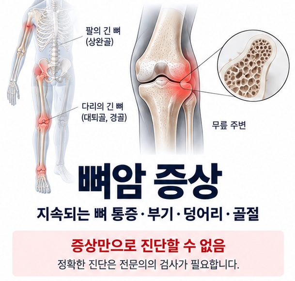 뼈암 증상과 지속되는 뼈 통증 부기 덩어리 골절 신호를 차분하게 보여주는 의료 교육용 이미지
