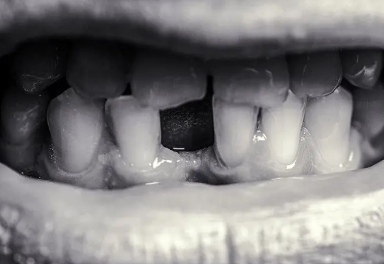 아랫니빠지는꿈