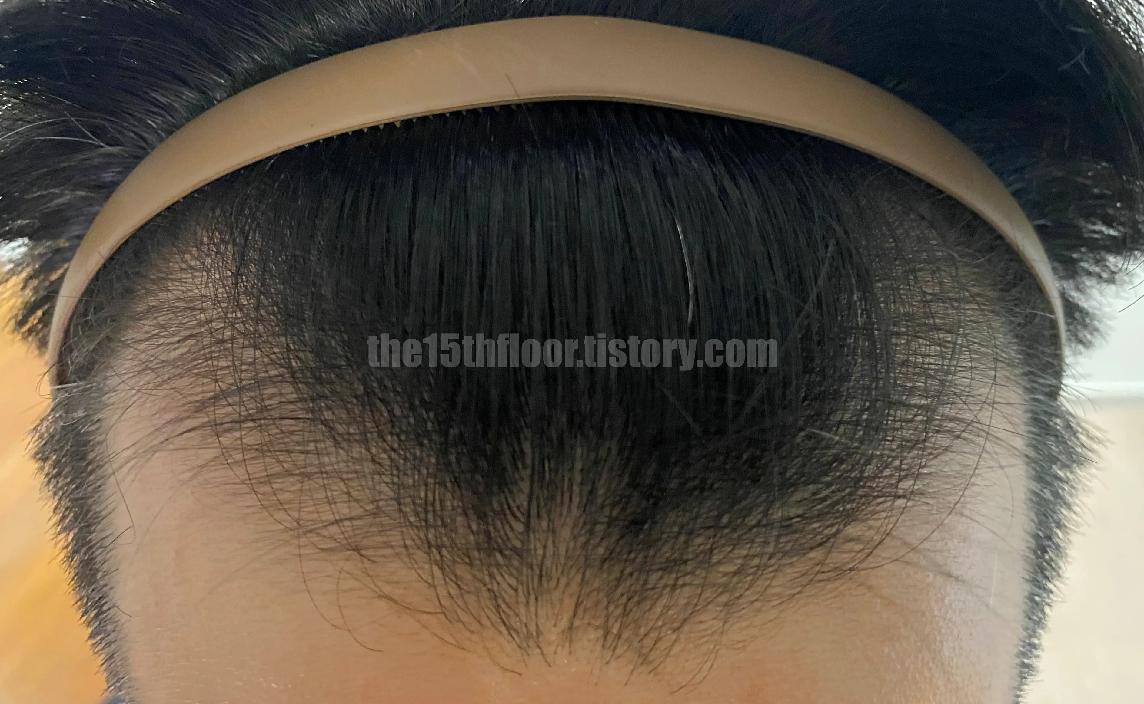 로게인폼 3개월 사용 후기 (사용 전)