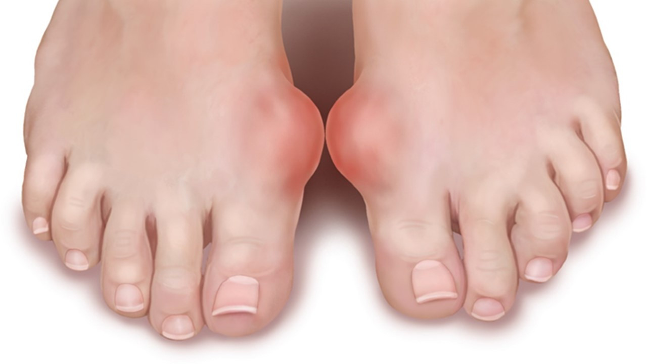 Gout Arthritis