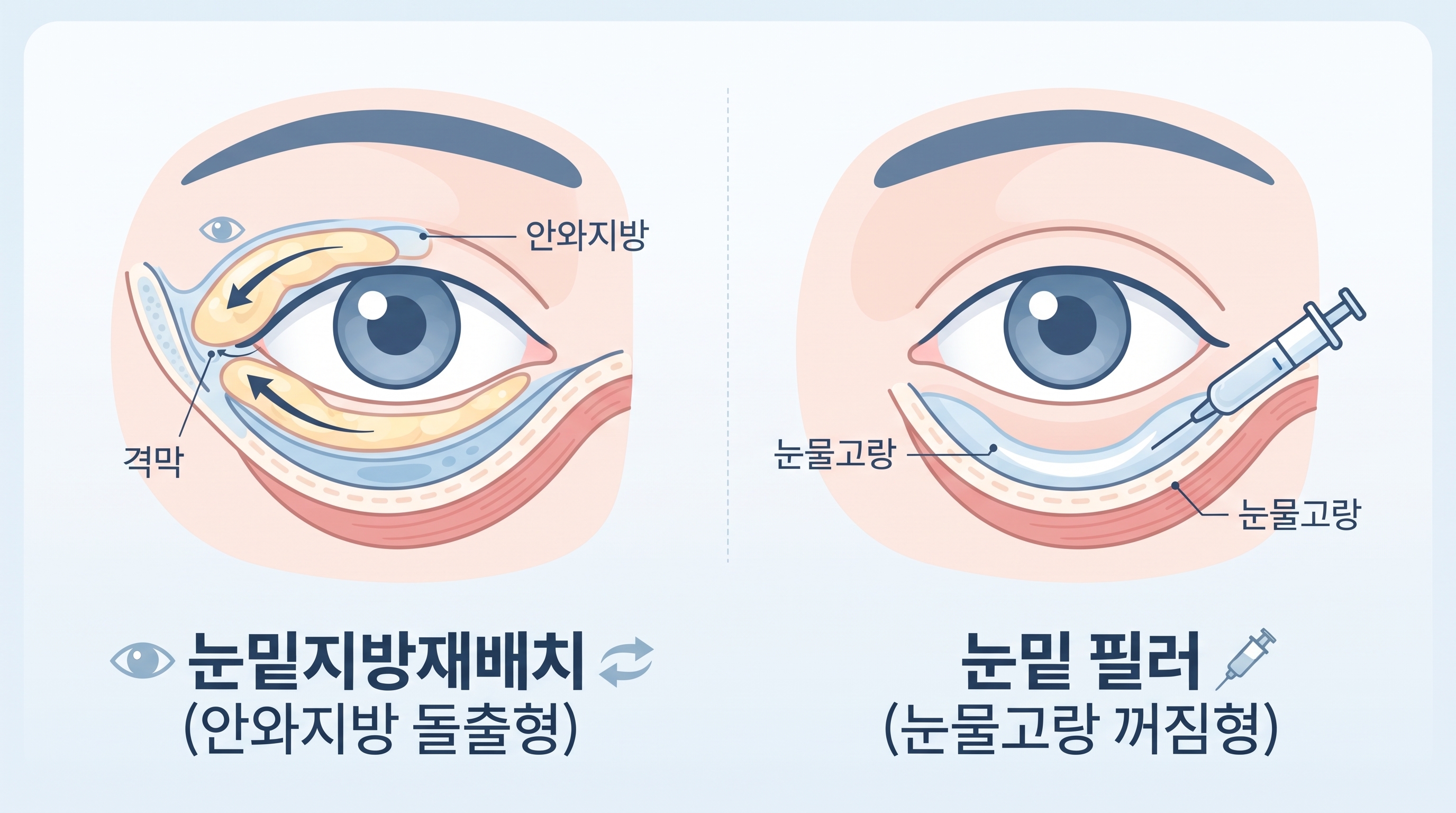 인체 눈밑 단면도 도식으로, 불룩하게 돌출된 안와지방을 이동&middot;재배치하는 눈밑지방재배치 원리와 꺼진 눈물고랑 부위에 볼륨 물질을 주입하는 눈밑 필러의 작용 위치를 깔끔한 파스텔톤 다이어그램으로 시각화한 이미지