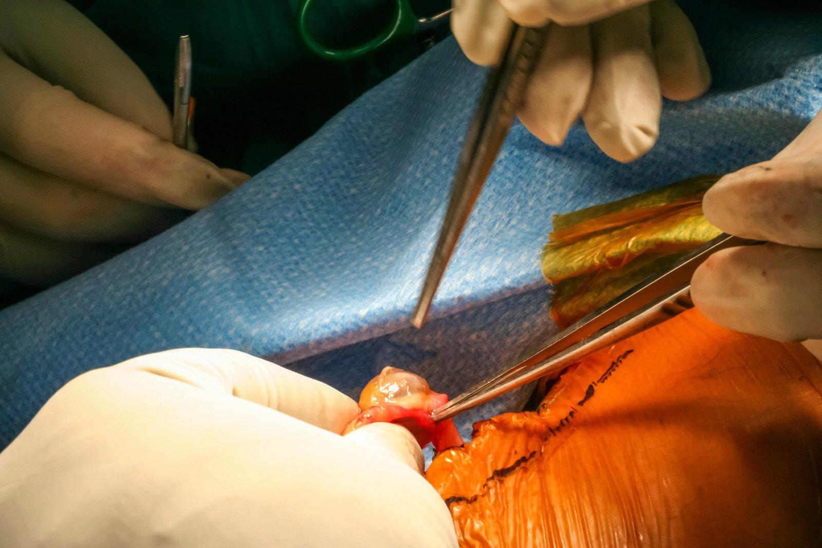 시신경 종양(Optic Nerve Tumor) &ndash; 원인, 증상, 치료법 총정리