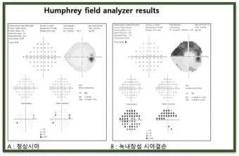 녹내장 진단 검사 비용 안압 검사주기 관리법_3
