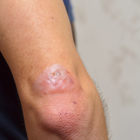 화상물집-치료방법