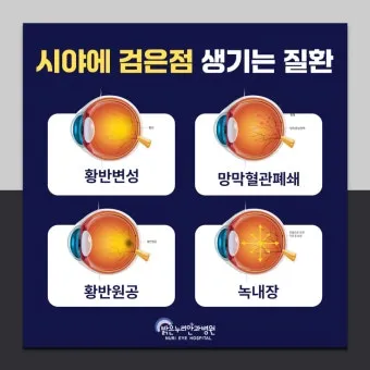 시야에 검은점 시야에 까만점이 보일때 원인과 대처법_28