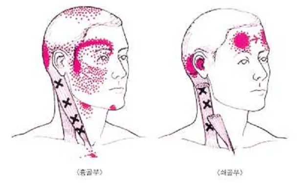 목빗근방사통