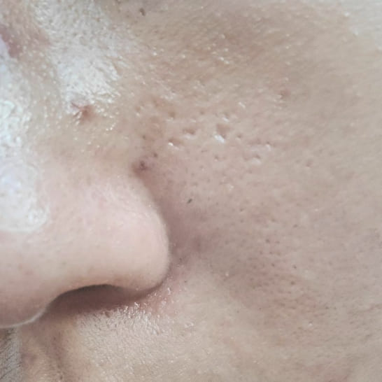acne-severe-case-treatment-example