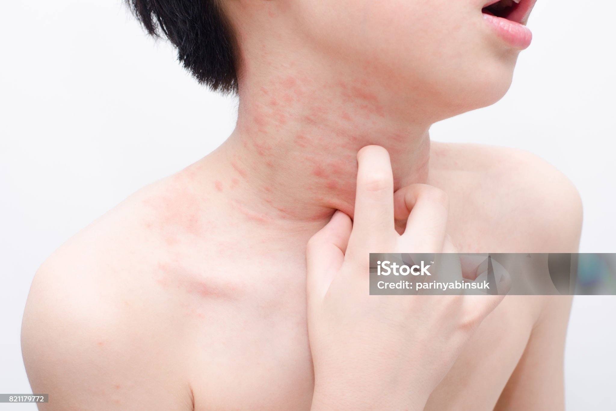 아이 두드러기 관련 사진