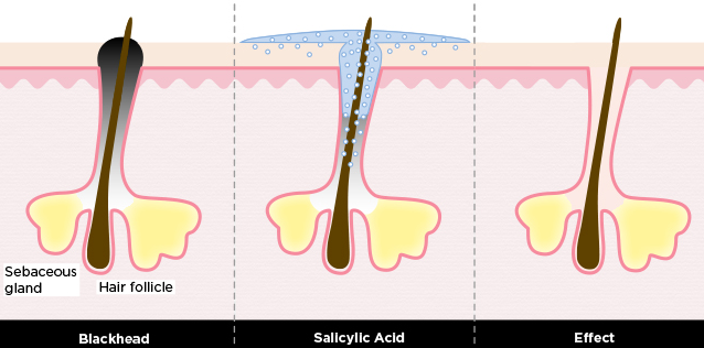 살리실산이-블랙헤드를-제거하는-원리