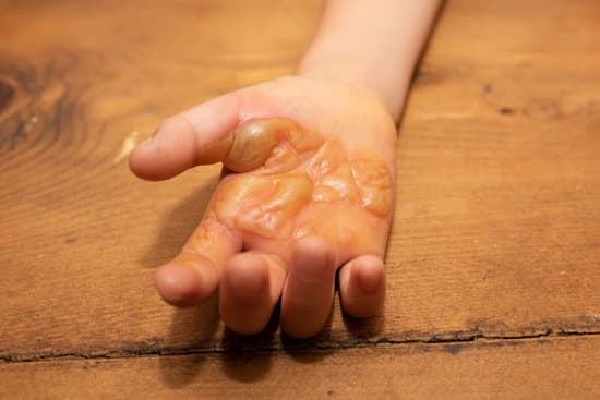 화상을 입었을때 대처 방법