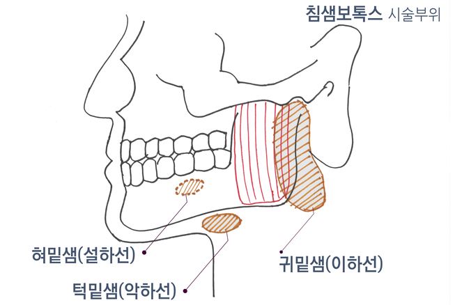 사각턱 보톡스