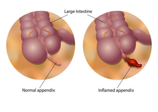 맹장 터지는 이유와 맹장염과 어떤 관계를 가지고 있는지도 알아봤습니다. 왜 맹장염이 파열로 이어질 수 있는 지와 맹장 벽이 왜 염증으로 약해지는지도 함께 읽어 보시기 바랍니다.