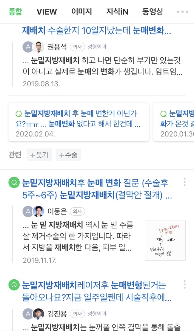 눈밑지방재배치 후기