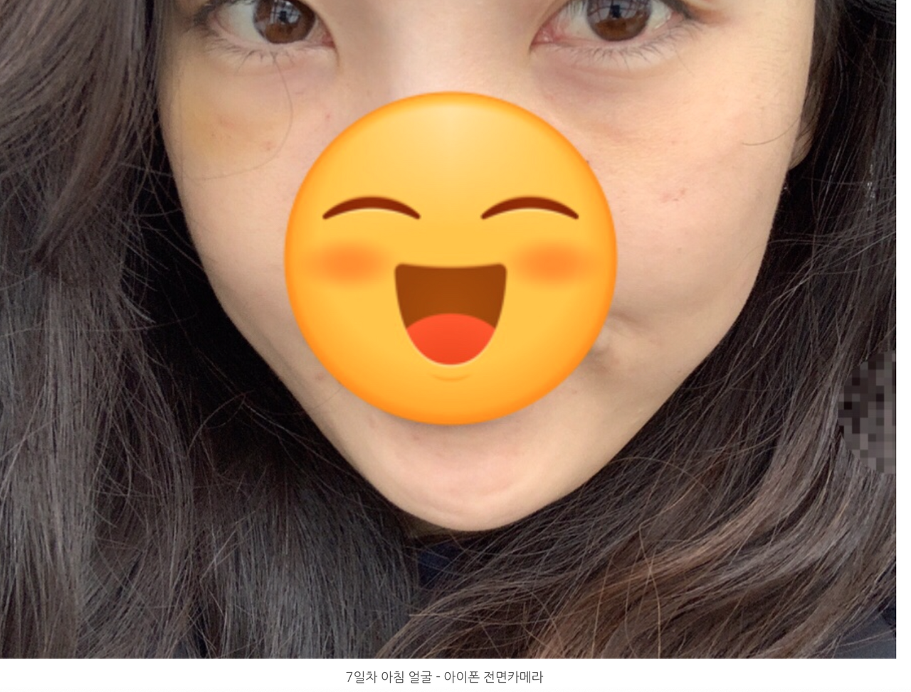 눈밑지방재배치 후기