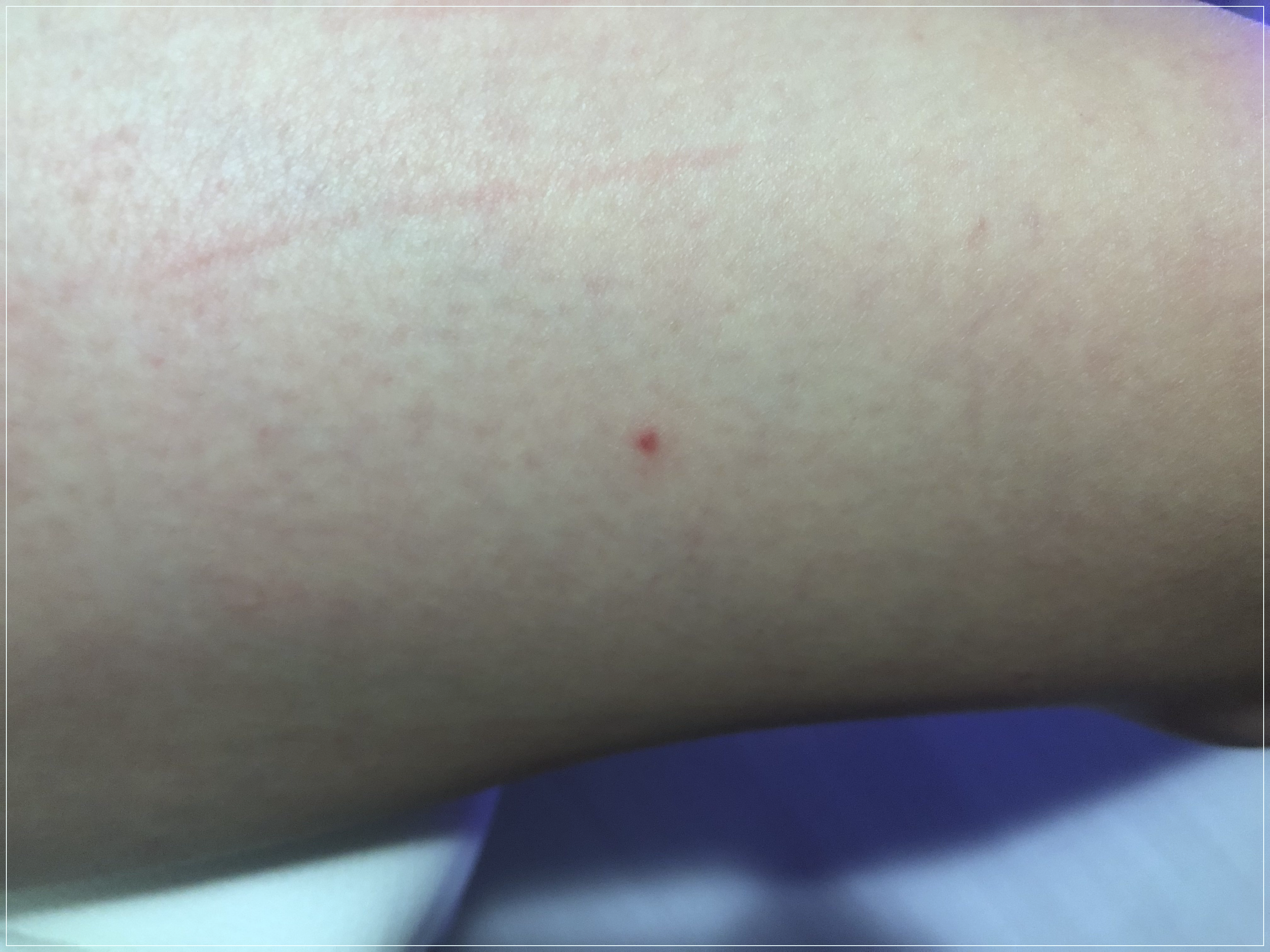 몸에-빨간점이-생기는-이유