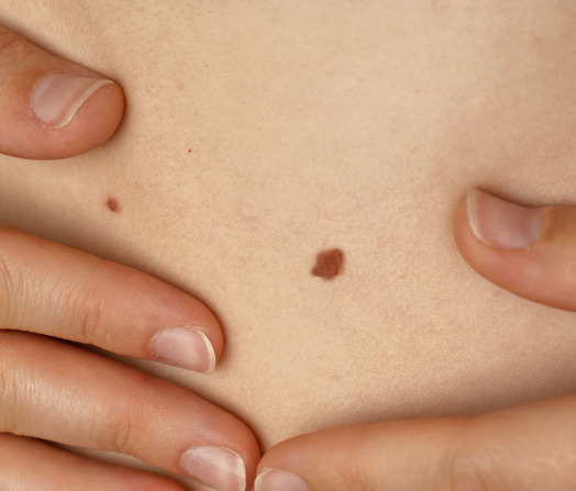 피부암 초기증상 4가지 총정리 섬네일