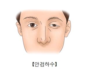 쳐진 눈