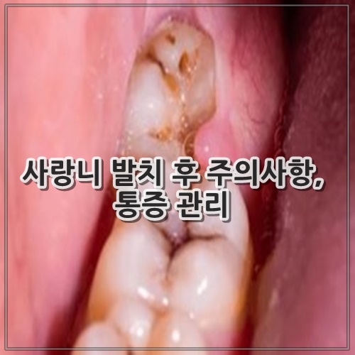 사랑니 발치 후 주의사항, 통증 관리