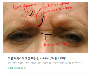 미간 주름 필러