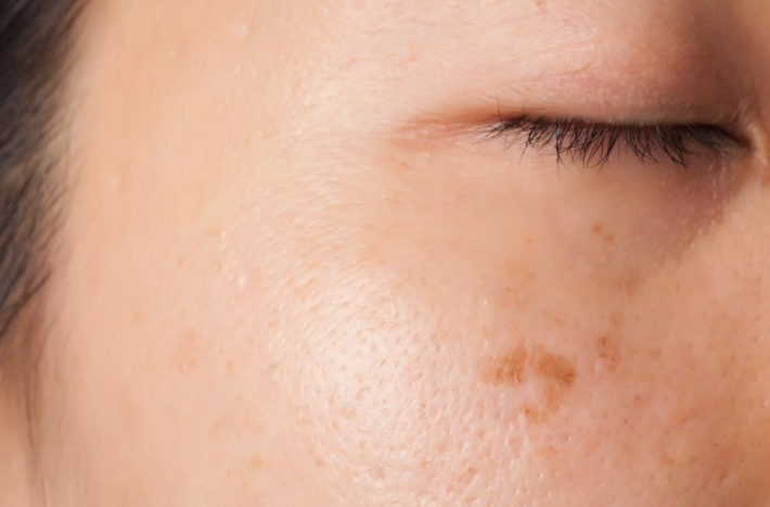 기미없애는방법