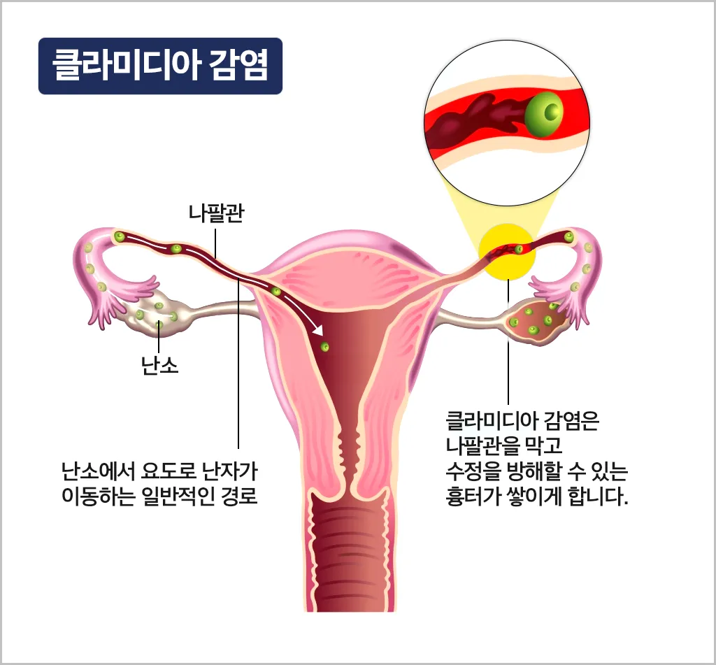 클라미디아-감염으로-불임이-되는-과정
