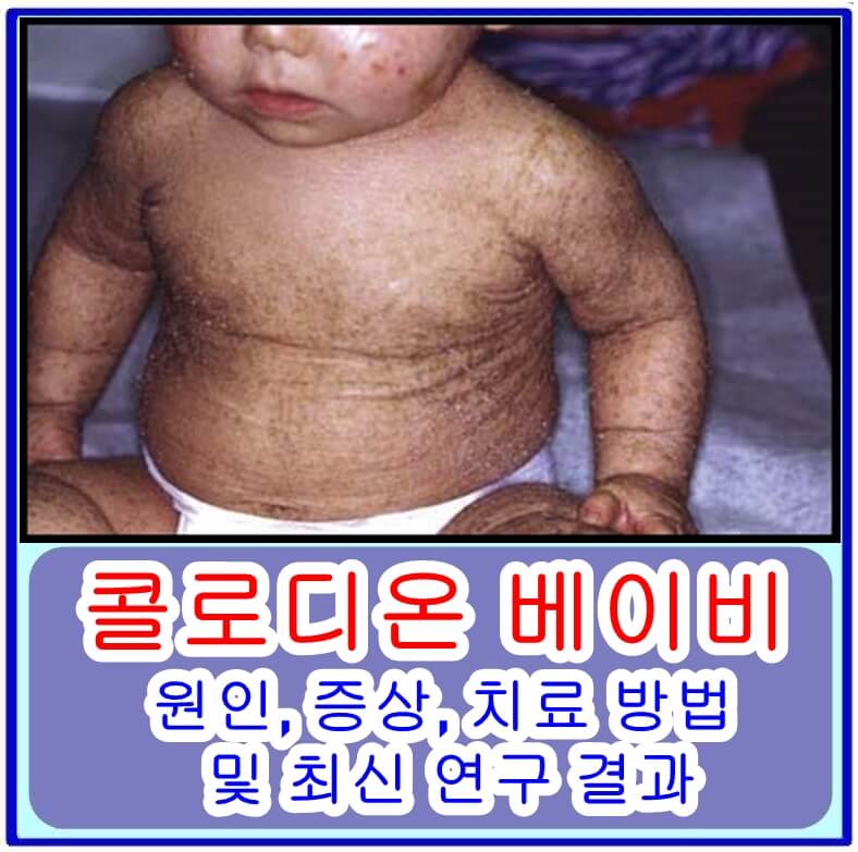 콜로디온 베이비
