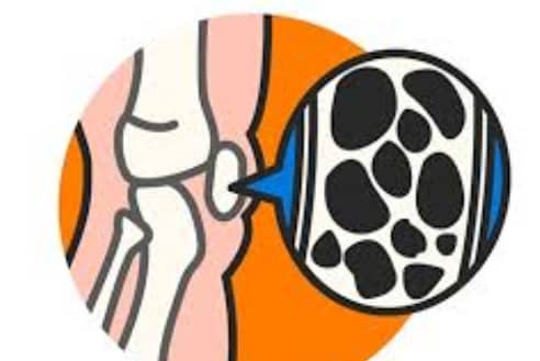 골다공증 이미지