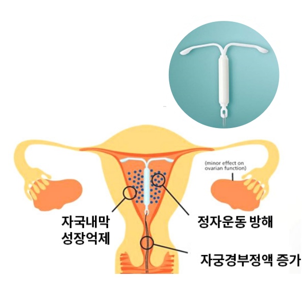 미레나 시술모습