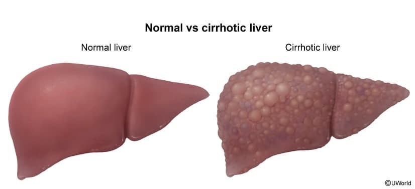 간경변 환자의 간호계획과 합병증 관리