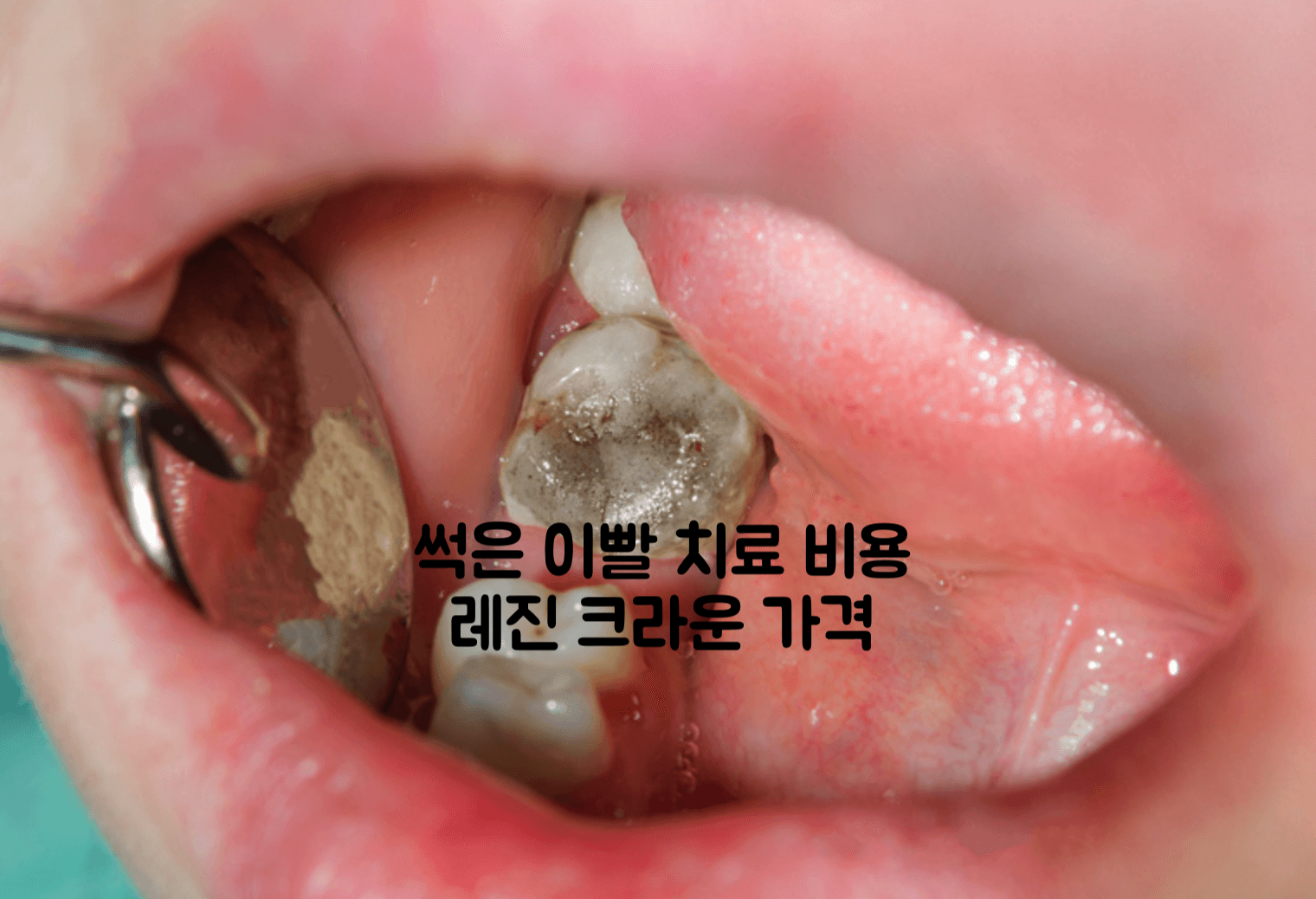 썩은 이빨 치료 비용