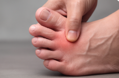 통풍 초기 증상