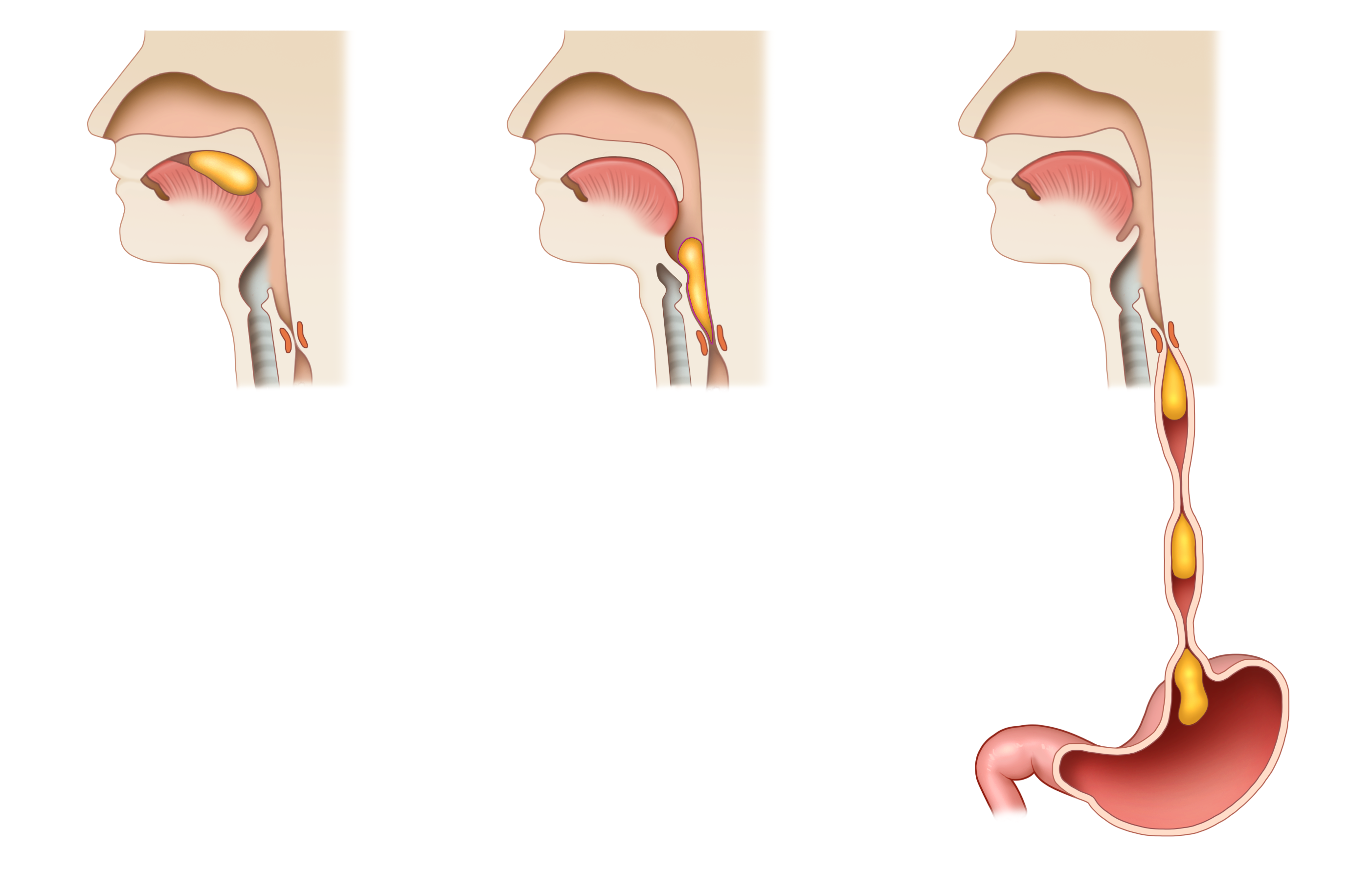 역류성 식도염 초기증상&amp;#44; 가볍게 넘기면 관리가 어려워지는 이유