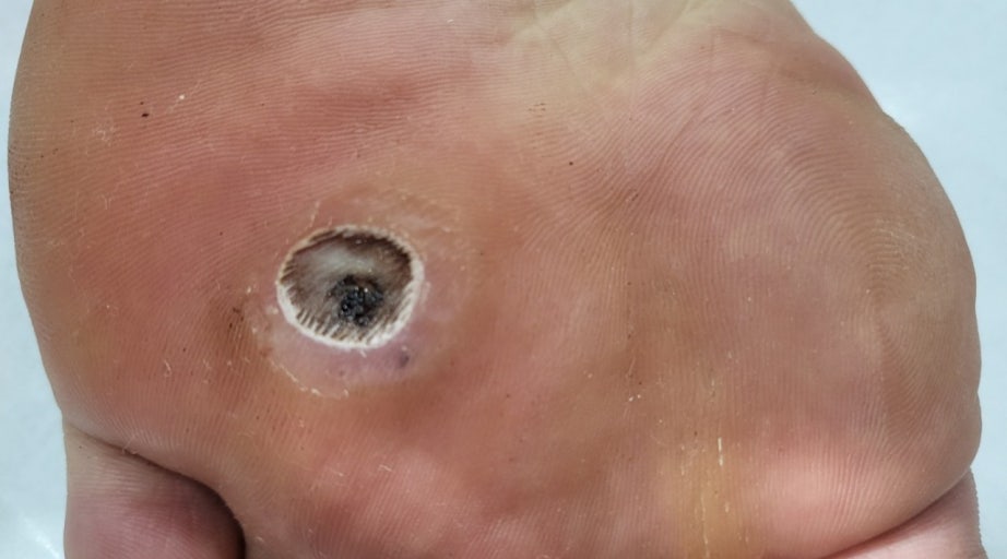 티눈이 있는 모습