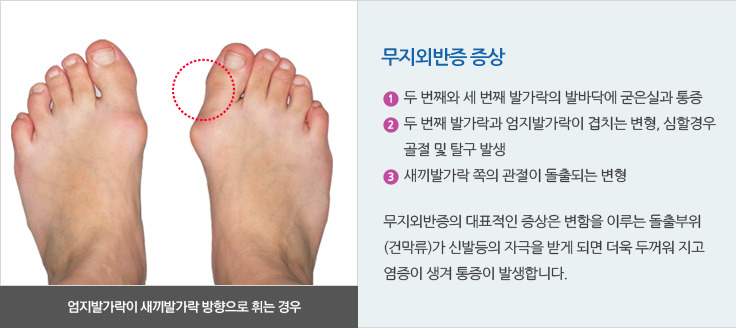 엄지발가락 통증의 원인 그리고 무지외반증이란?