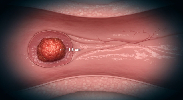 염증으로 붉게 보이는 방광을 표현한 방광염 일러스트