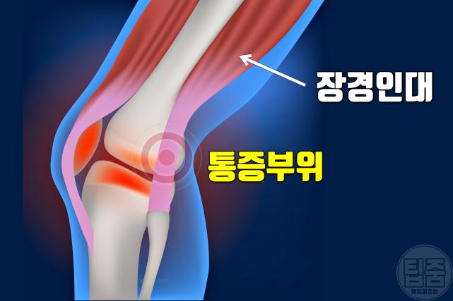 무릎 뒤 통증 원인 장경인대증후군