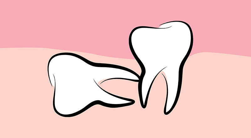 옆으로 누운 사랑니