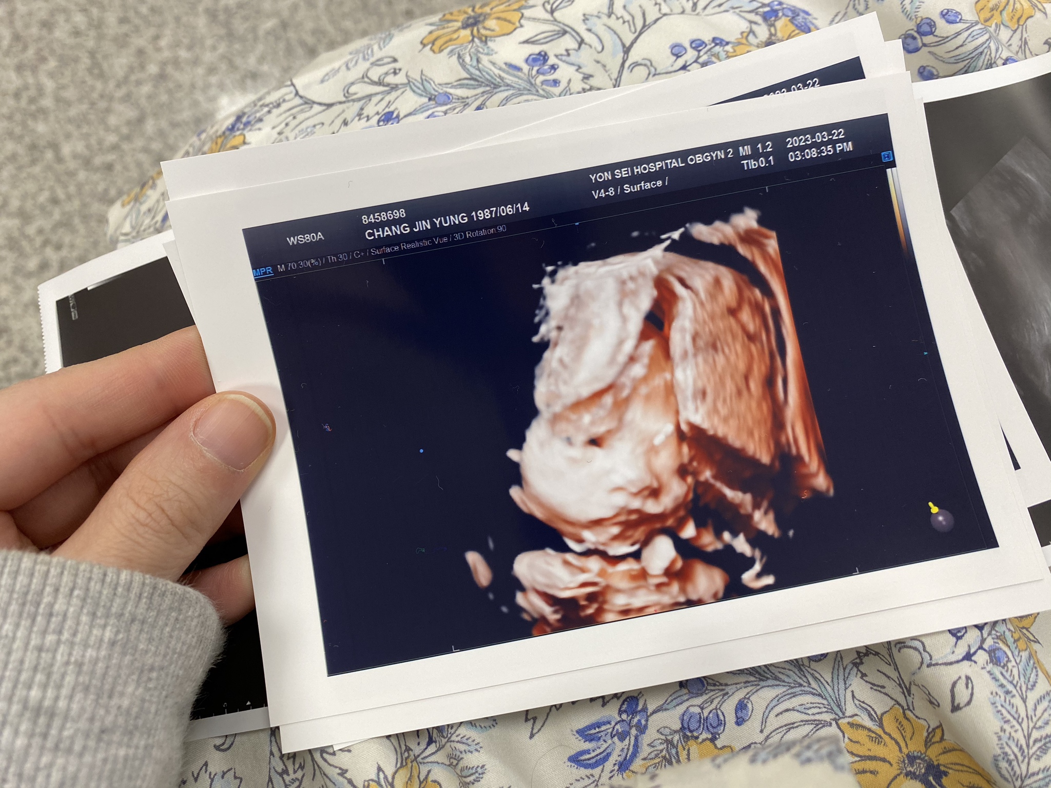 세브란스입체초음파