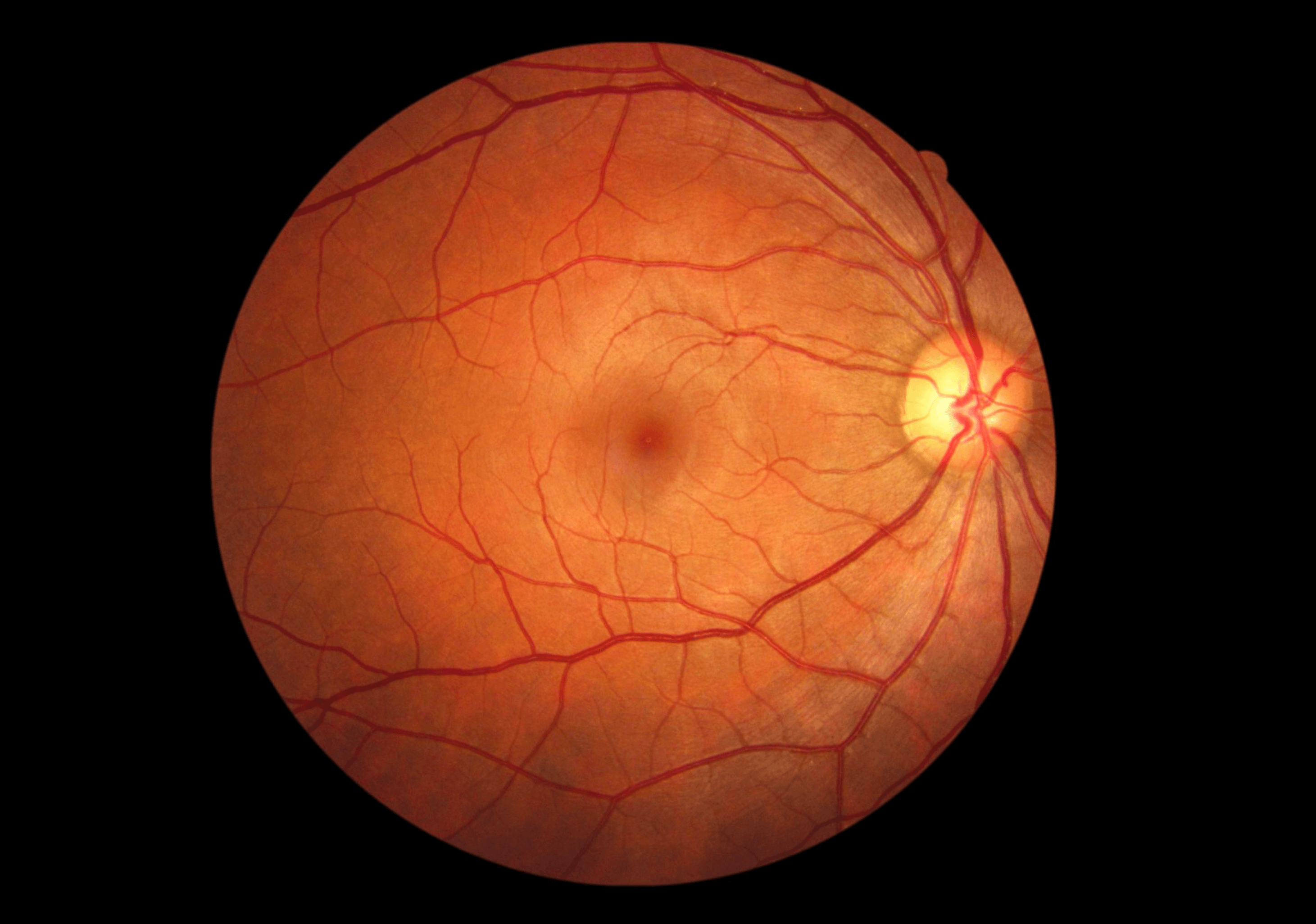 망막열공 시술후
