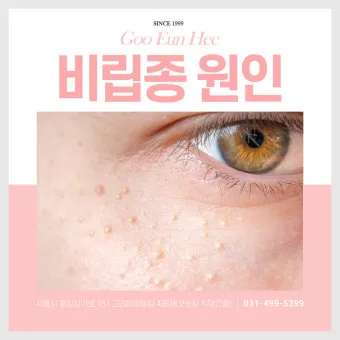 비립종 생기는 이유 비립종 없애는 방법 피부 관리법_18