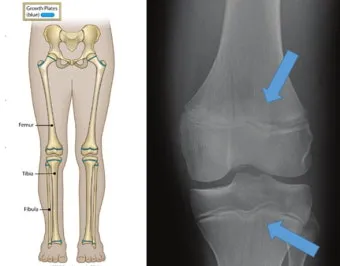성장판 닫혀도 키 클 수 있는 방법과 성장 호르몬 시기_17