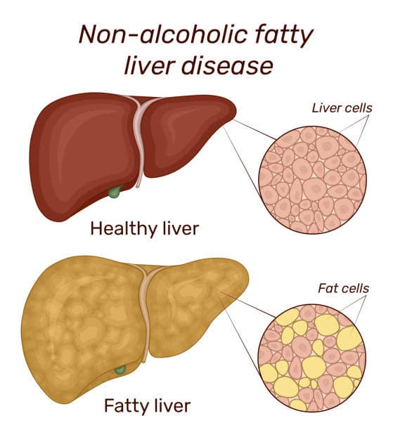 지방간 ( Faty liver )