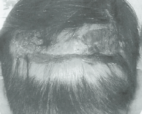 모발이식 3000모 비용, 부작용 정리