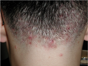 두피 뾰루지 없애는 방법 두피 관리는 이렇게