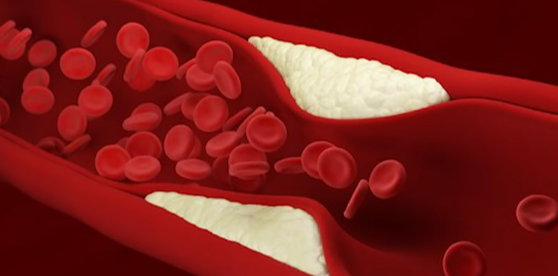 뇌졸중과 심근경색