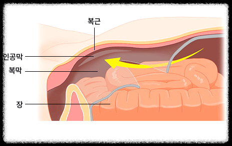 복강경 수술