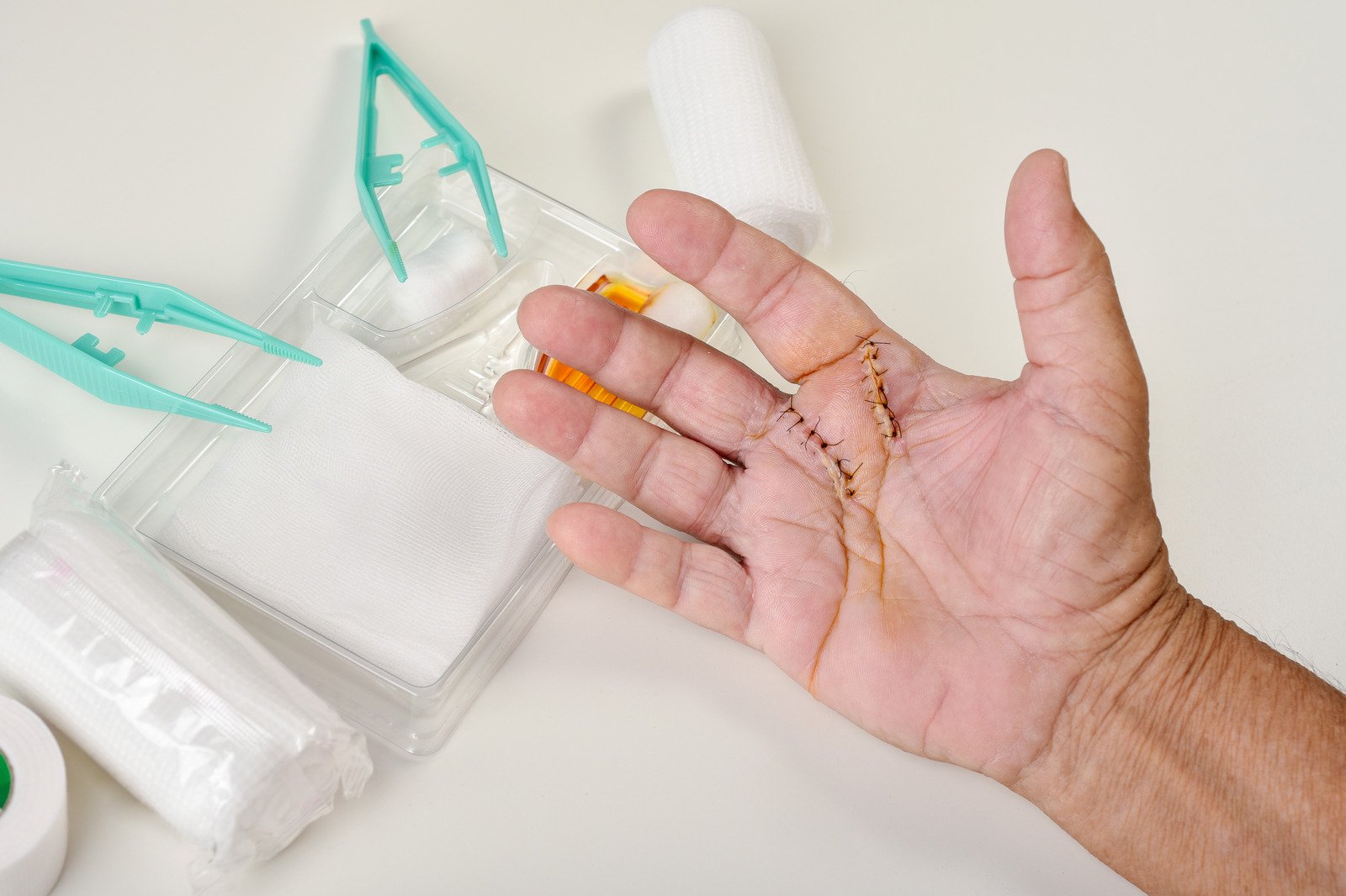 트리거 핑거 수술