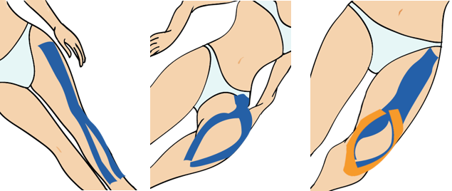 무릎 통증(물고임)